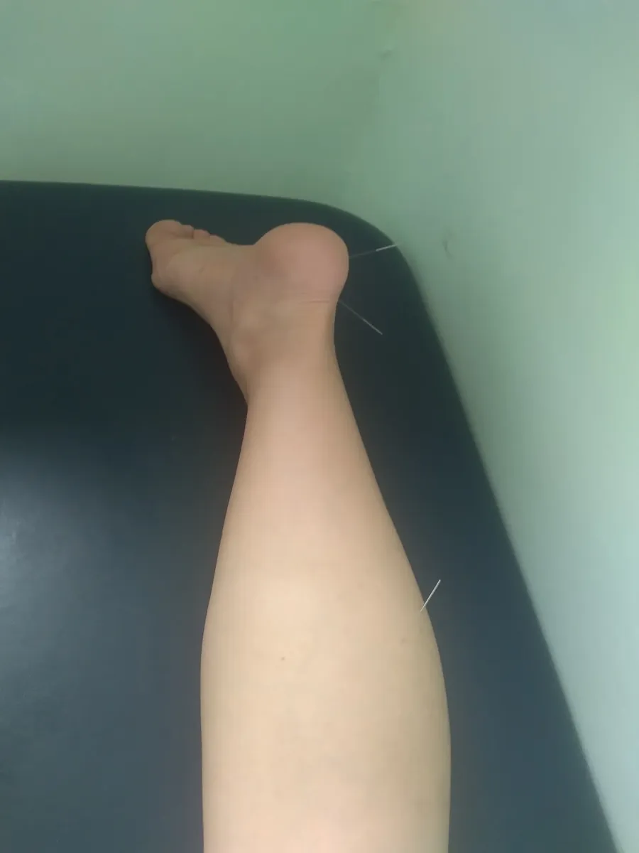 Acupuntura